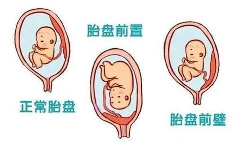 植入性胎盤 風水禁忌